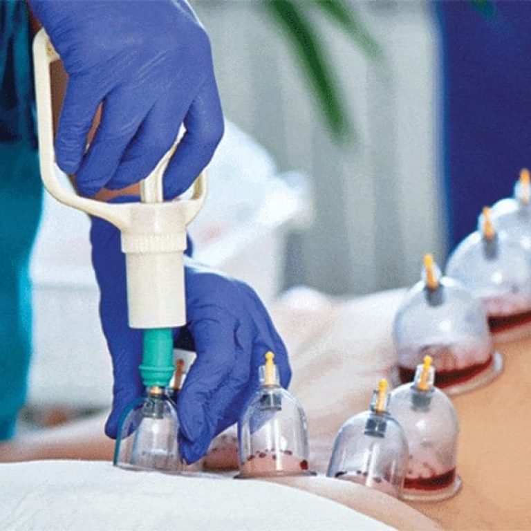 hijama-image